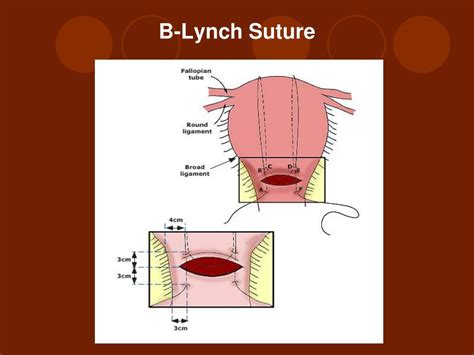 external compression sutures test|Postpartum hemorrhage: Management approaches requiring .